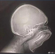 拍牙片時打了個哈欠，變成了毒液？用3D打印技術制作牙齒的好處